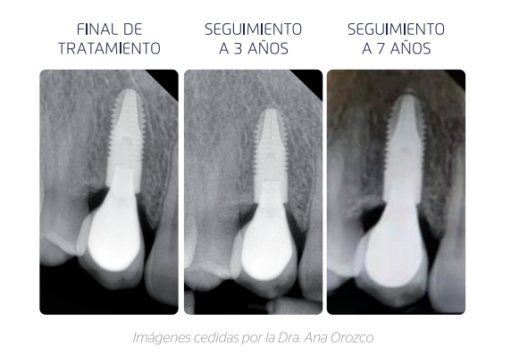 Mantenimiento Hueso Marginal